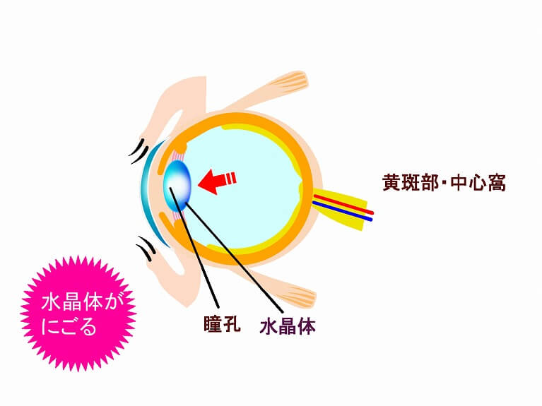 白内障とは