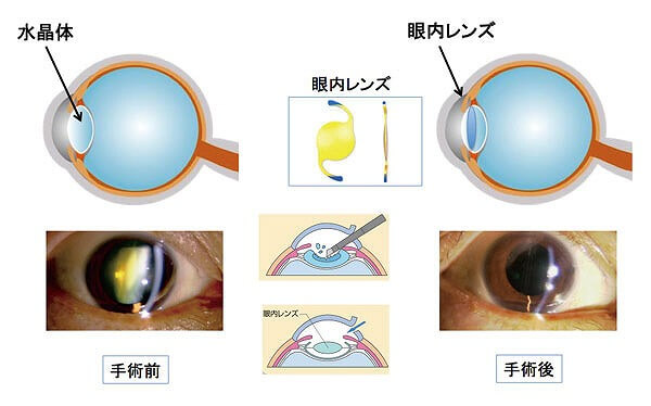 人工の透明な眼内レンズ