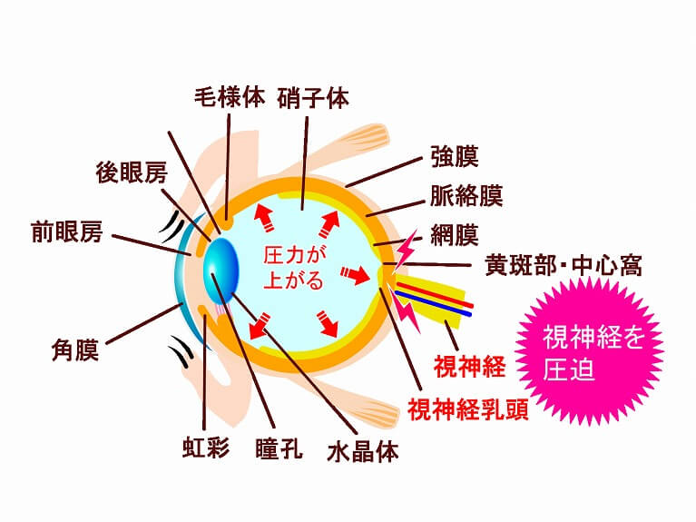 緑内障の原因