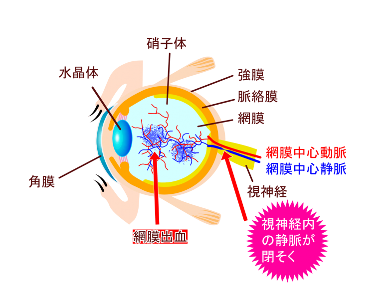 加齢黄斑変性