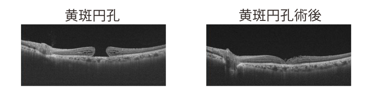 黄斑円孔と黄斑円孔術後