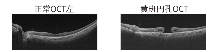 正常OCTと黄斑円孔OCT