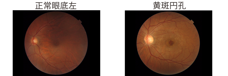 正常眼底（左）と黄斑円孔