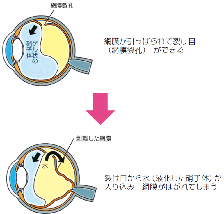 裂孔 生活 後 網膜 術 レーザー