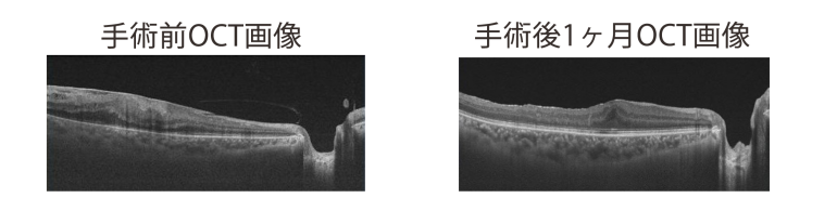 手術前OCT画像・手術後1ヶ月OCT画像