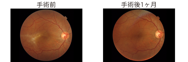 手術前・手術後1ヶ月