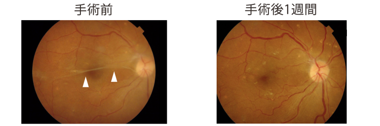 手術前・手術後1ヶ月