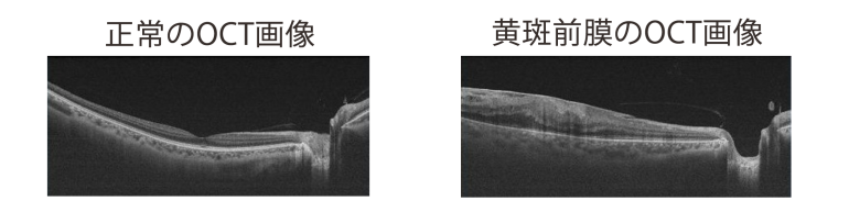 正常のOCT画像