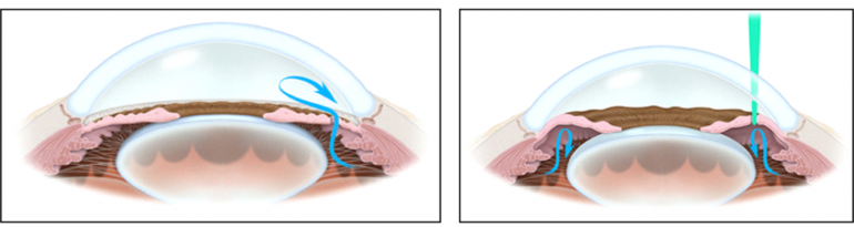 レーザー虹彩切開術（ＬＩ）