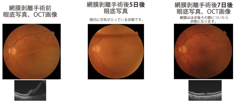 網膜剥離手術前の眼底写真と網膜剥離手術後の眼底写真
